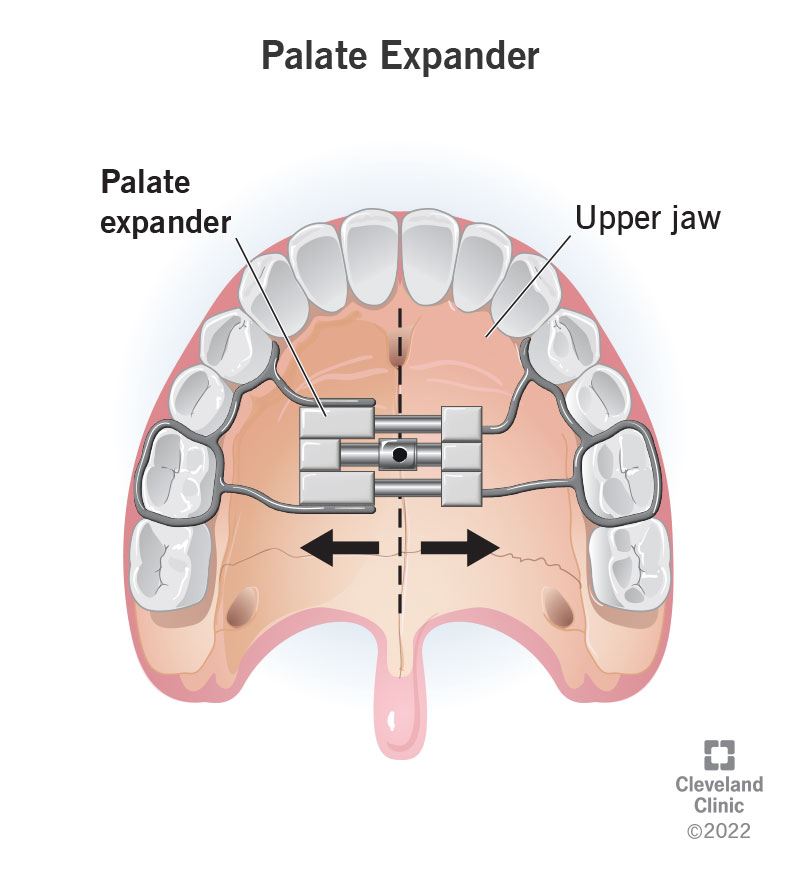 A palate expander fits in the roof of your mouth. It moves the two halves of your upper jaw apart.