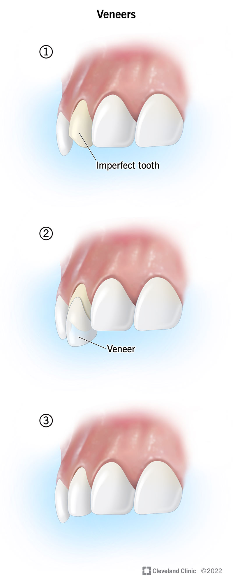 A veneer can conceal a chipped tooth and make your smile more uniform.