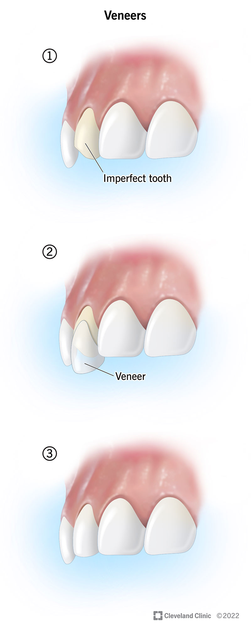 Porcelain Teeth Veneers