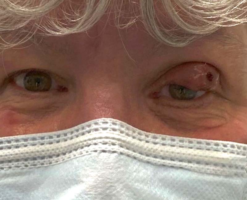 A photo of periorbital cellulitis in the tissue near a person's left eye.