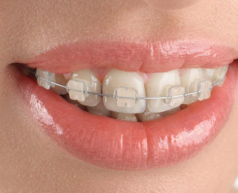 Clear Braces - Nearly Invisible Teeth Straightening for White