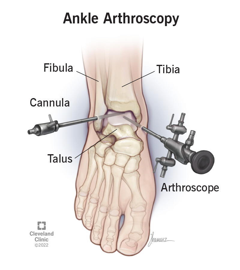 An ankle arthroscopy performed on a person’s right ankle.