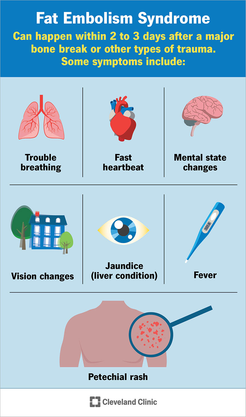 Symptoms of fat embolism syndrome can include trouble breathing, fever, vision changes and a fast heartbeat.