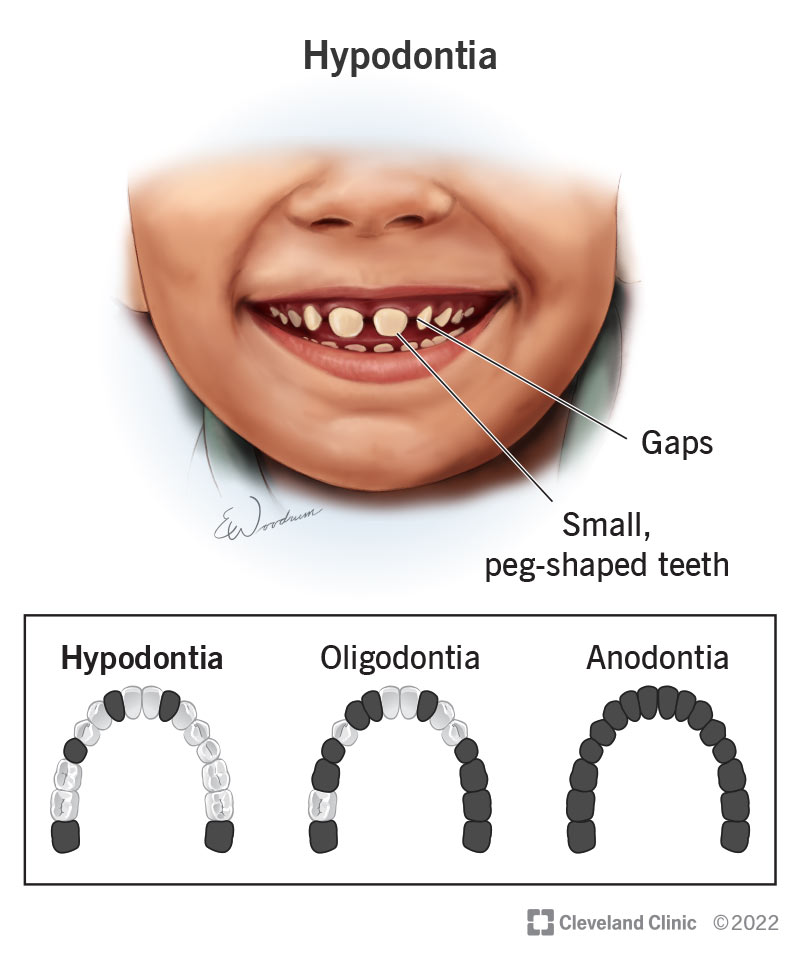 Child with small, peg-shaped teeth, a symptom of hypodontia.