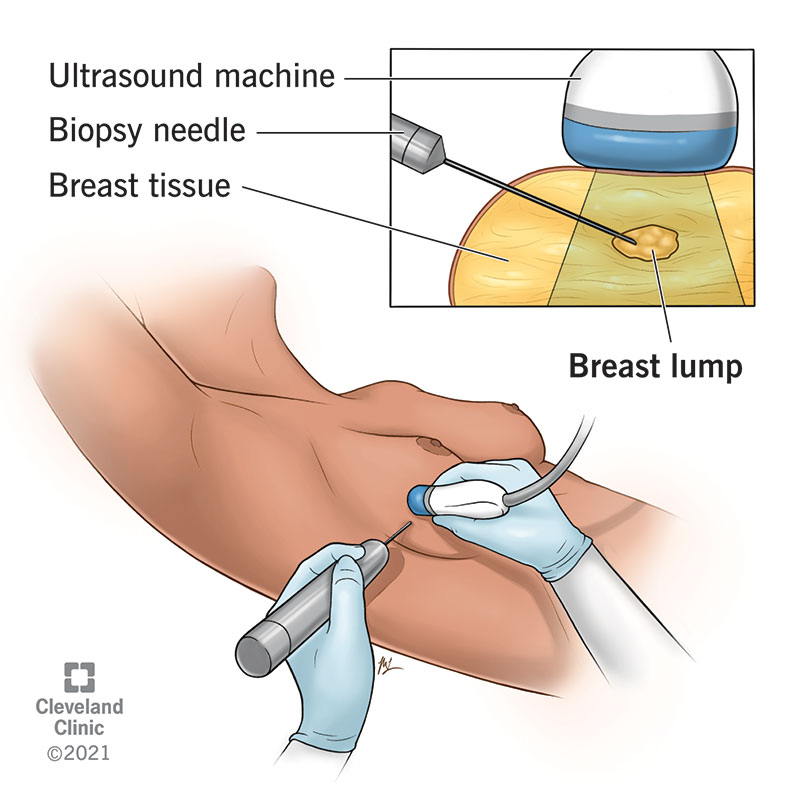 Illustration of an ultrasound-guided breast biopsy showing the ultrasound probe, biopsy needle and suspicious breast tissue.