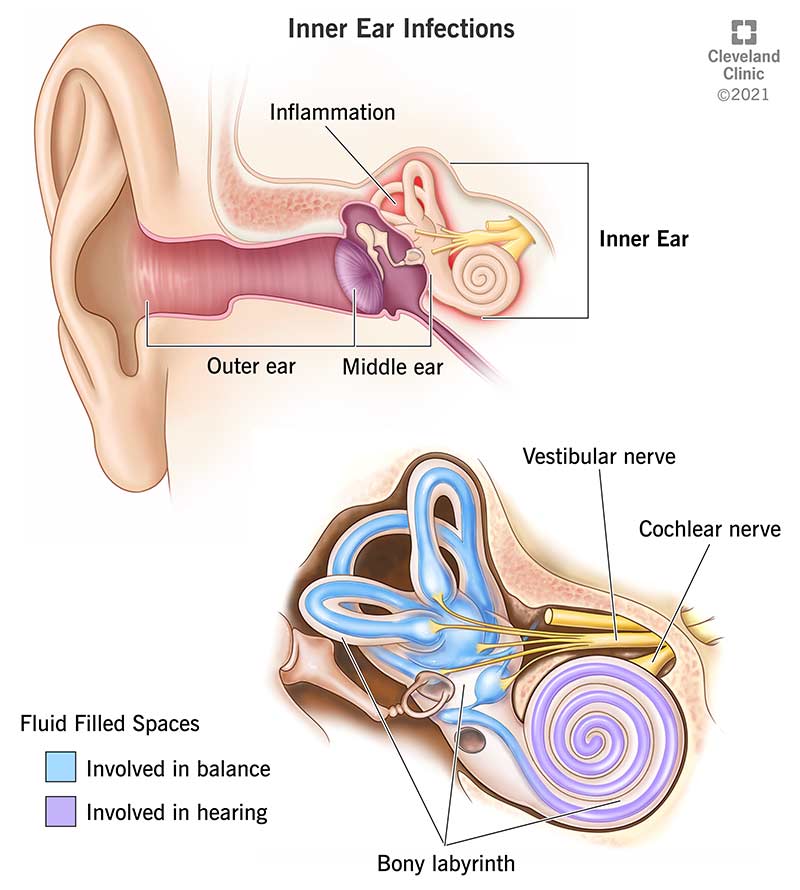 Ear Infection (Otitis Media): Symptoms, Causes & Treatment