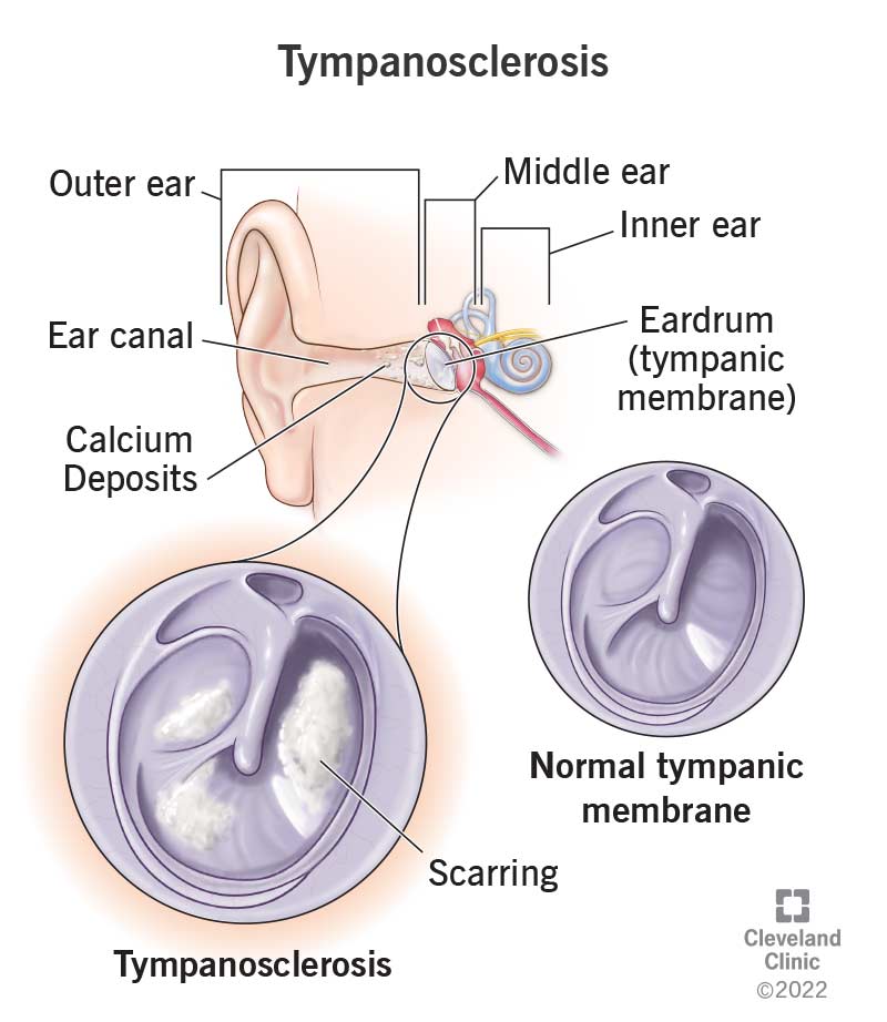 Normal tympanic membrane vs. tympanosclerosis.