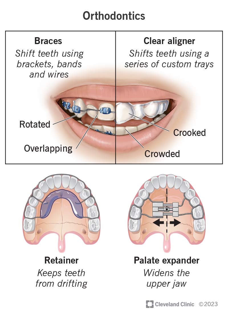 Orthodontic appliances, including braces, aligners, retainers and palate expanders.