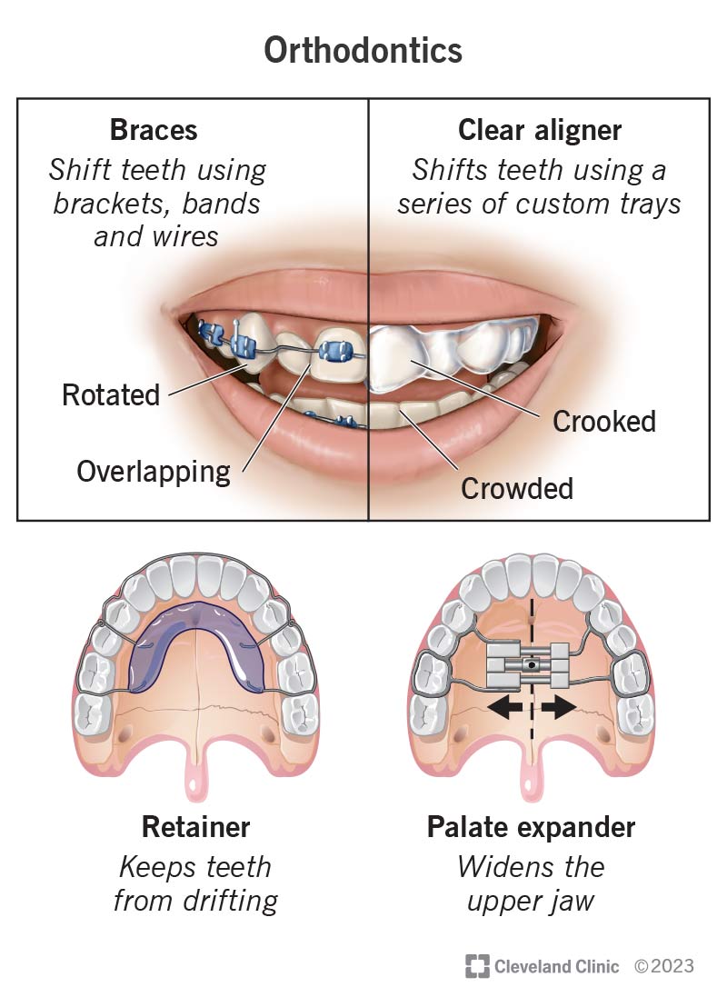 Braces