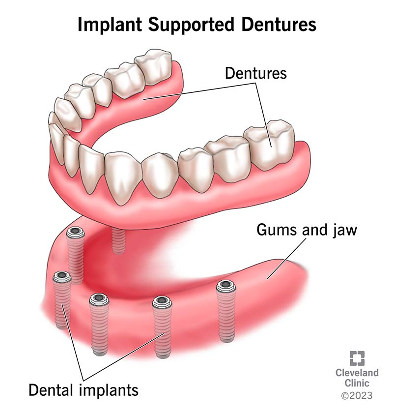 Implant-supported dentures and how they "snap on" to dental implants in jaw.