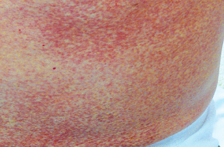 myelodysplastic syndrome skin