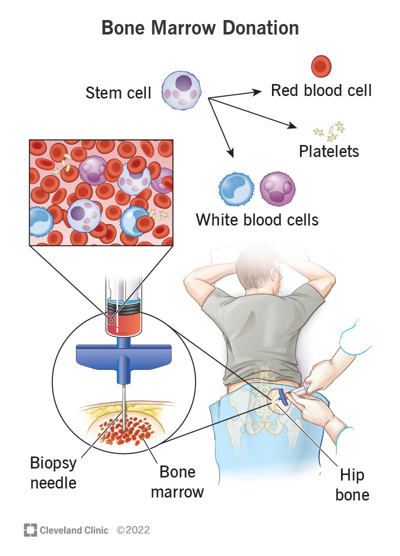 Stem cells (top) become red blood cells (top right), platelets (center) and white blood cells (top left). (Bottom right) Healthcare provider obtaining bone marrow for use in stem cell transplantation. Close up of stem cells (left) being collected from bone marrow (right) with large hollow needle called a biopsy needle.