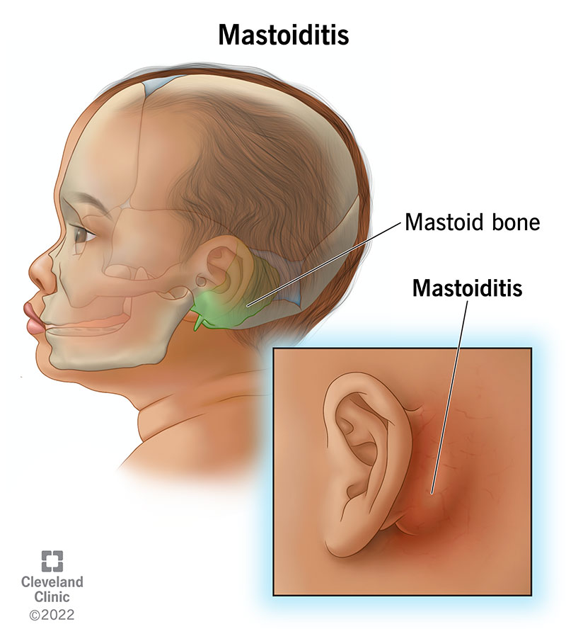 Child in profile showing mastoid bone location. Inset shows swelling behind ear that is mastoiditis symptom.