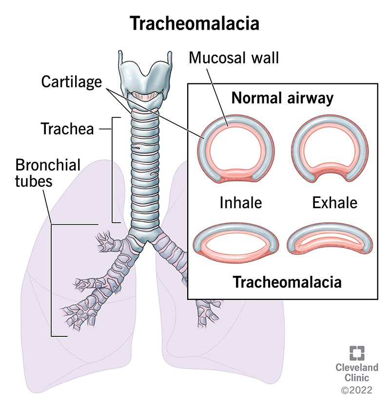 Normal airway vs. tracheomalacia.