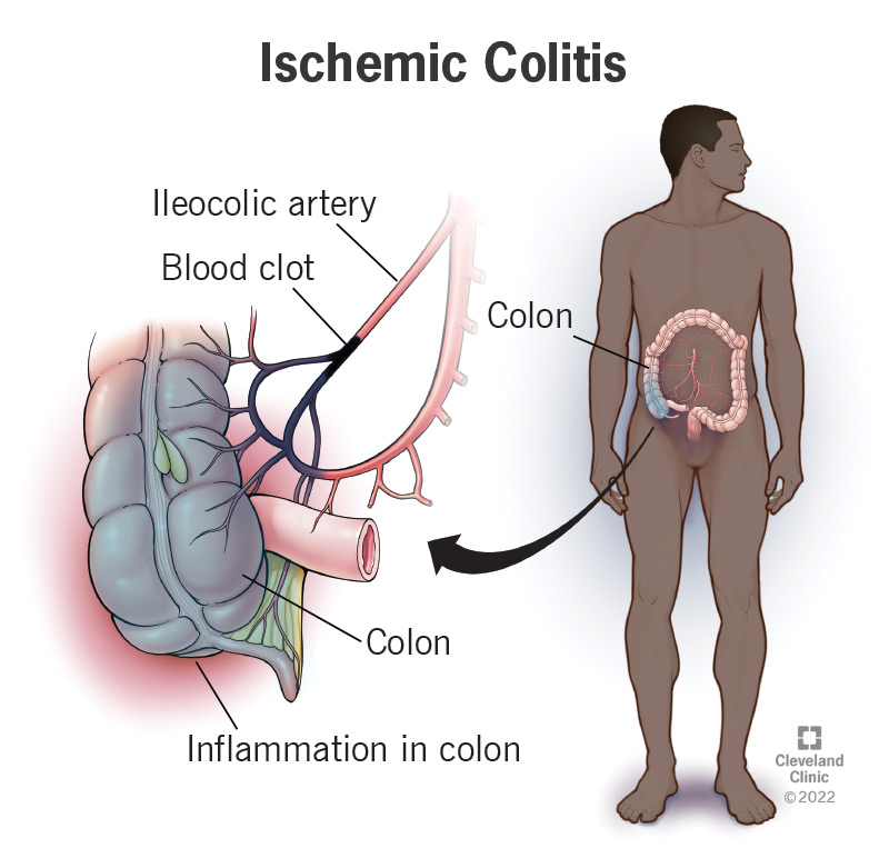 A blood clot can stop blood flow to your colon.