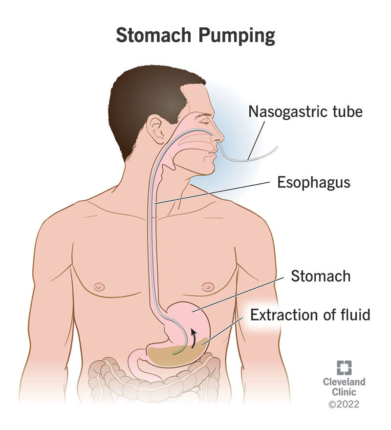 Stomach pumping or gastric suctioning draws out the contents of your stomach through a tube.