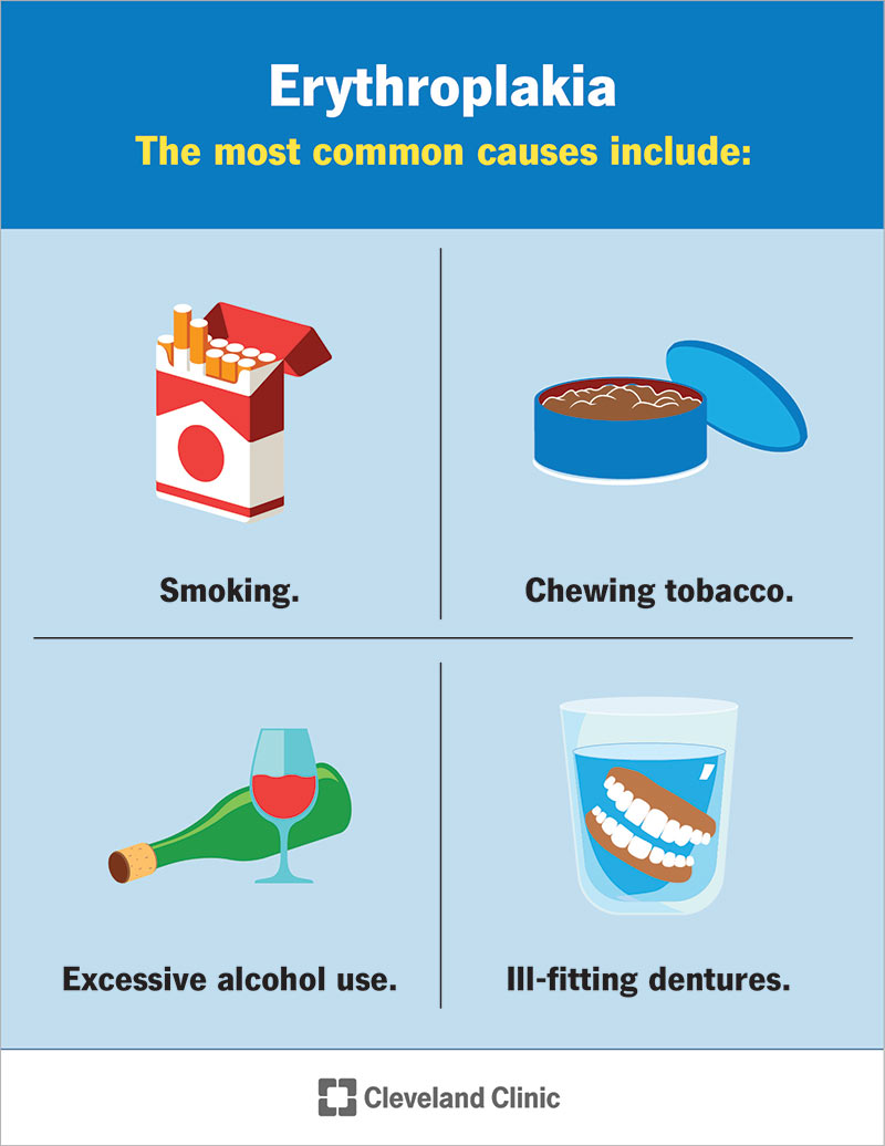 Erythroplakia causes include ill-fitting dentures, tobacco and alcohol use.