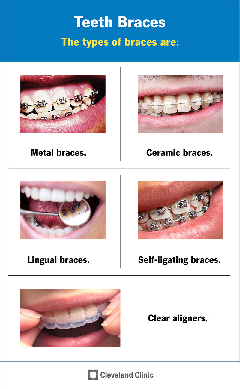The different types of braces are metal, ceramic, lingual, self-ligating and clear aligners.
