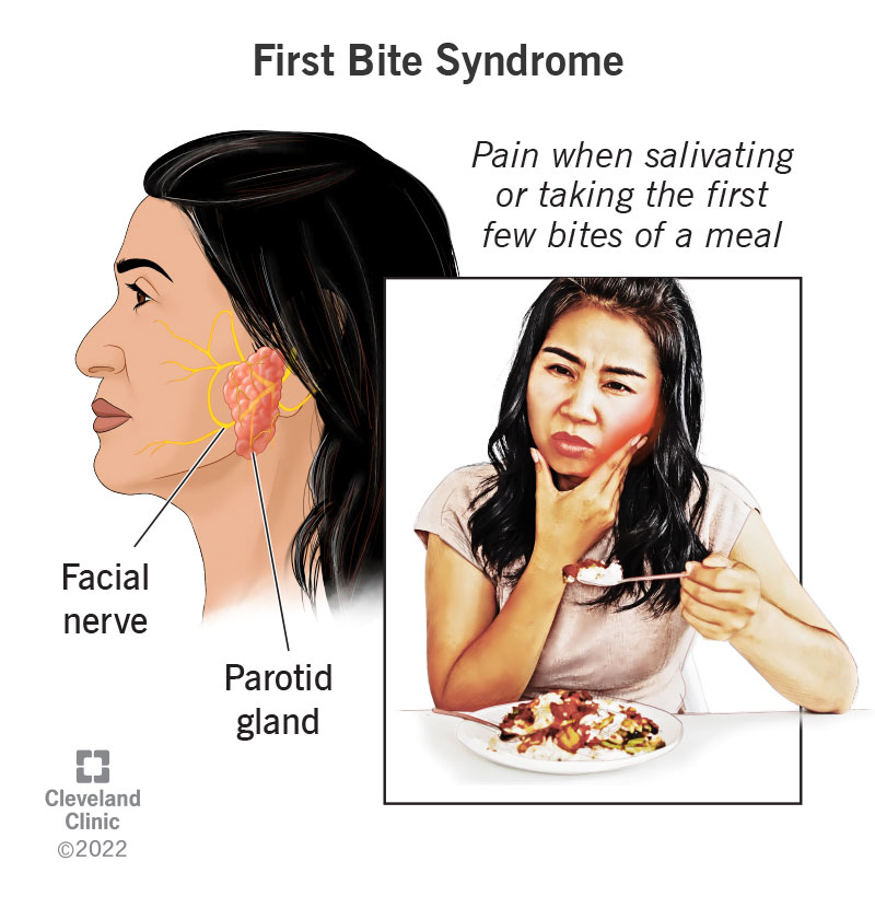People with first bite syndrome develop pain when salivating or first few bites of a meal