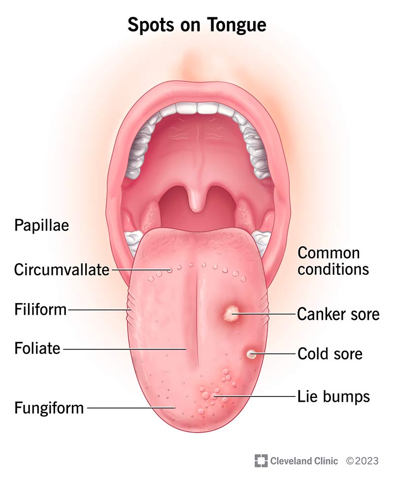 Types of normal and abnormal spots on tongue, including types of taste buds, cold sores and canker sores.