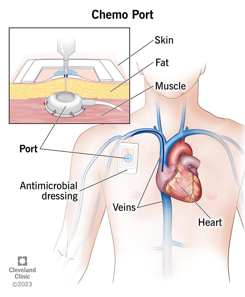 Chemo port location and injection site.