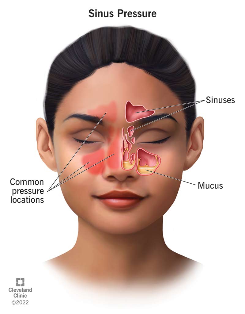 Common areas to feel sinus pressure.
