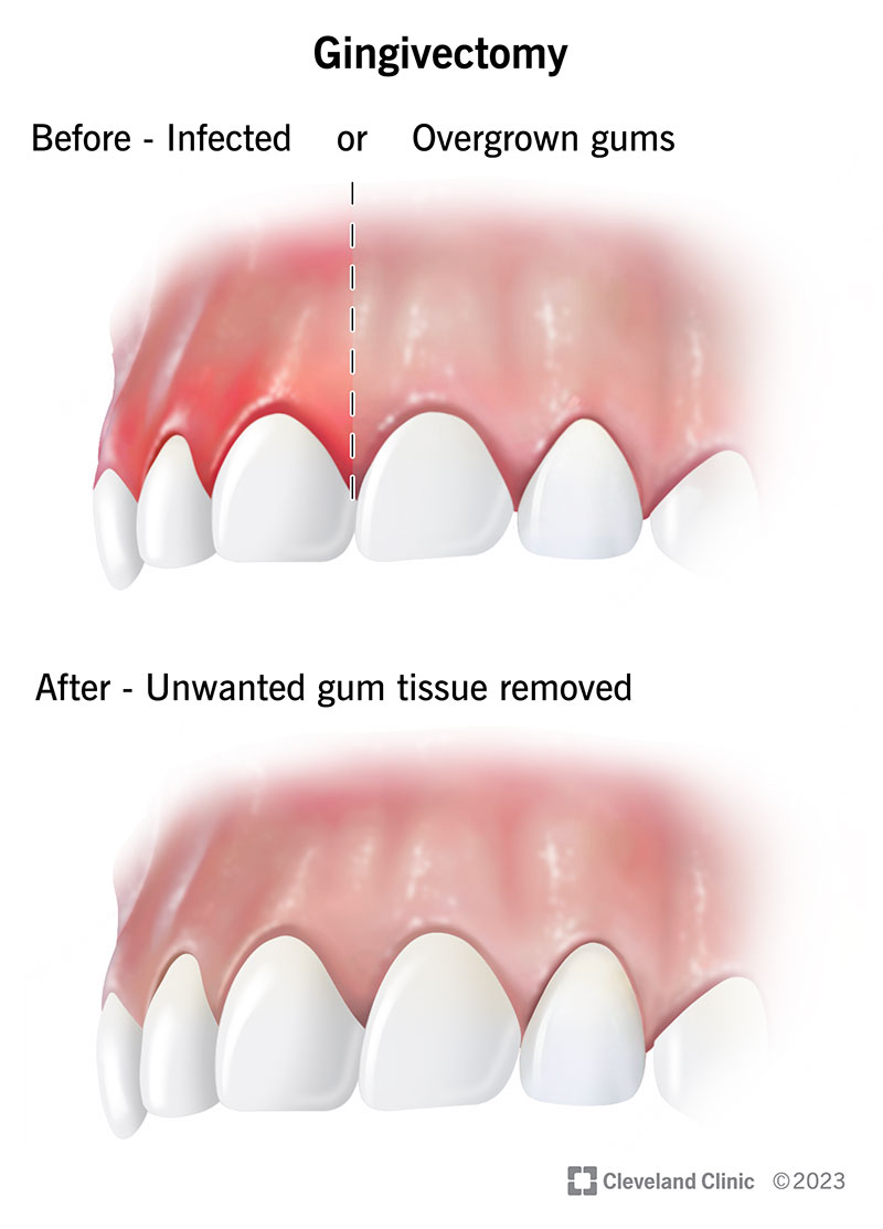 receding gums surgery before and after