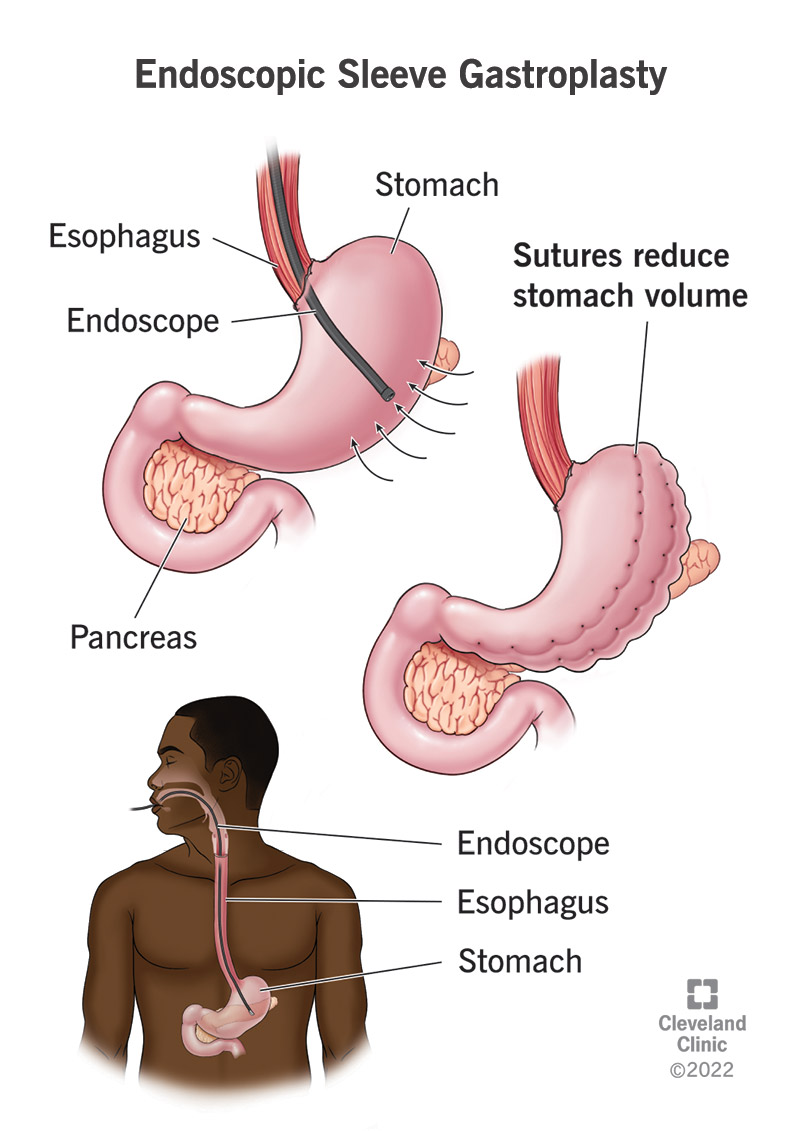 Endoscopic sleeve gastroplasty reduces your stomach volume by closing off a portion with stitches.