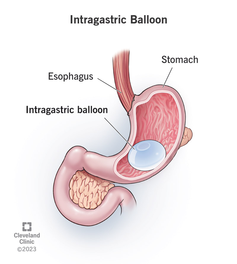 An intragastric balloon is placed inside your stomach, where it takes up about 1/3 of the space.