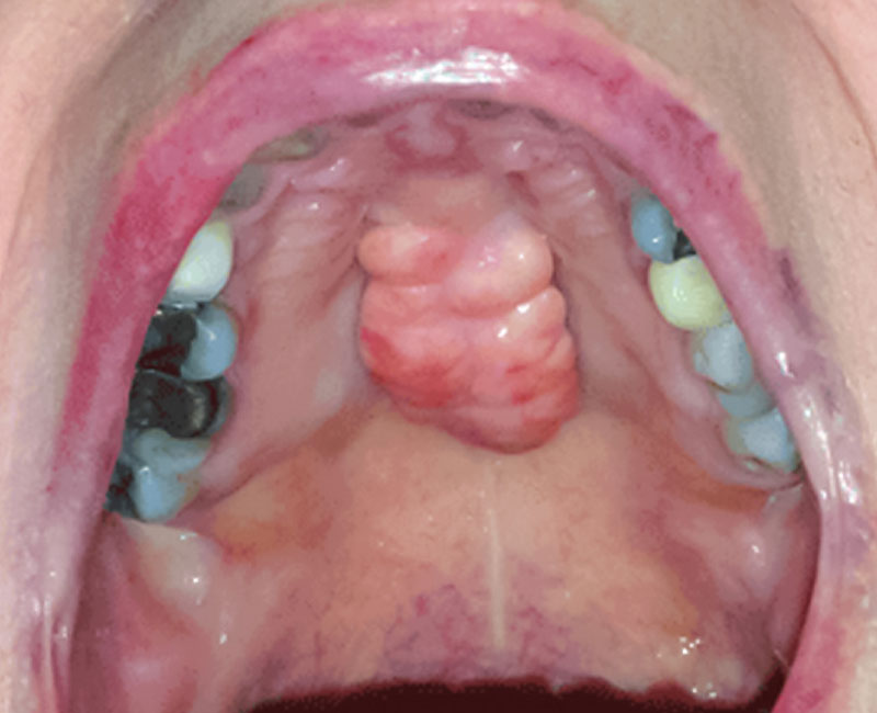 Torus palatinus (bony growth) on person’s palate (roof of mouth).