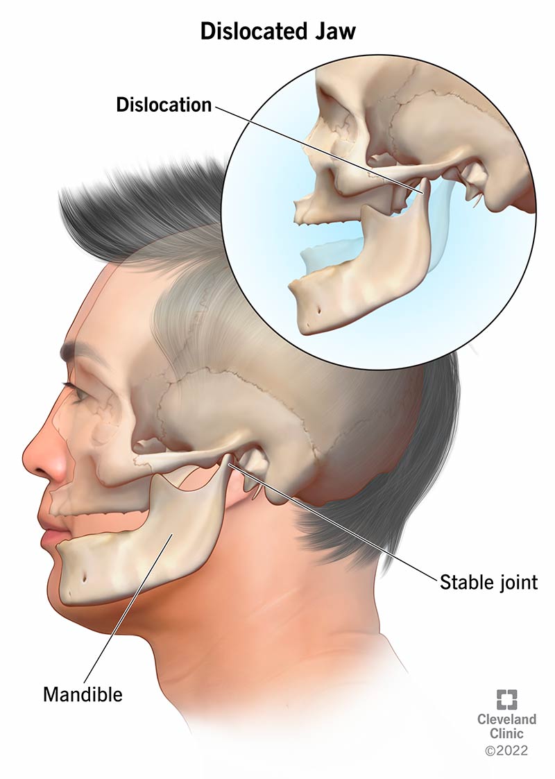 Lower jaw (mandible) connected to a temporomandibular joint.