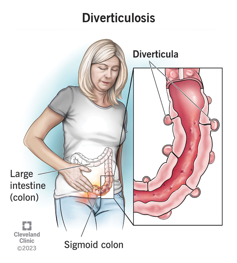 Diverticulosis: What It Is, Symptoms, Causes & Treatment