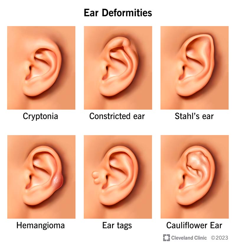 Pictures of ear deformities: cryptonia, constricted ear, Stahl's ear, hemangioma, accessory tragus and cauliflower ear.