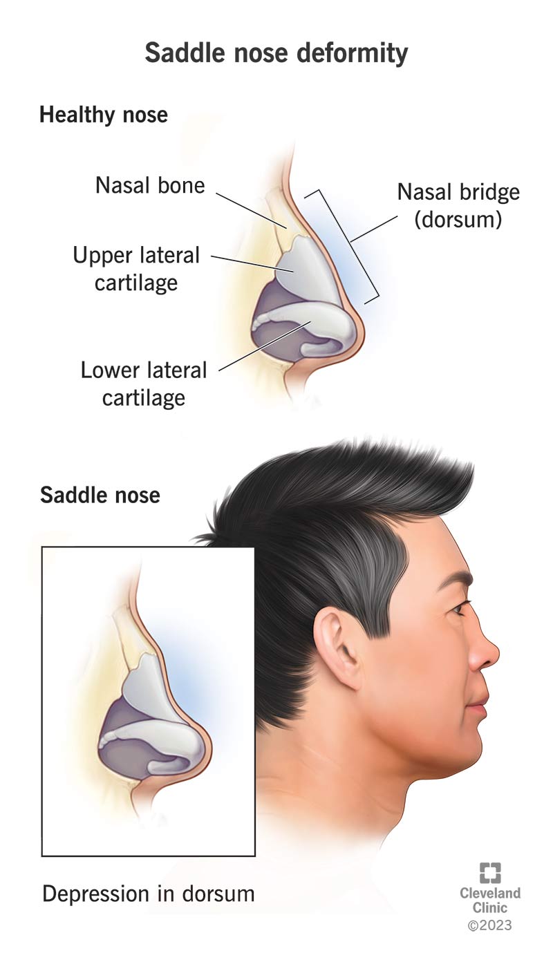 Saddle nose deformity vs. healthy nose, showing depression in dorsum (nose bridge).