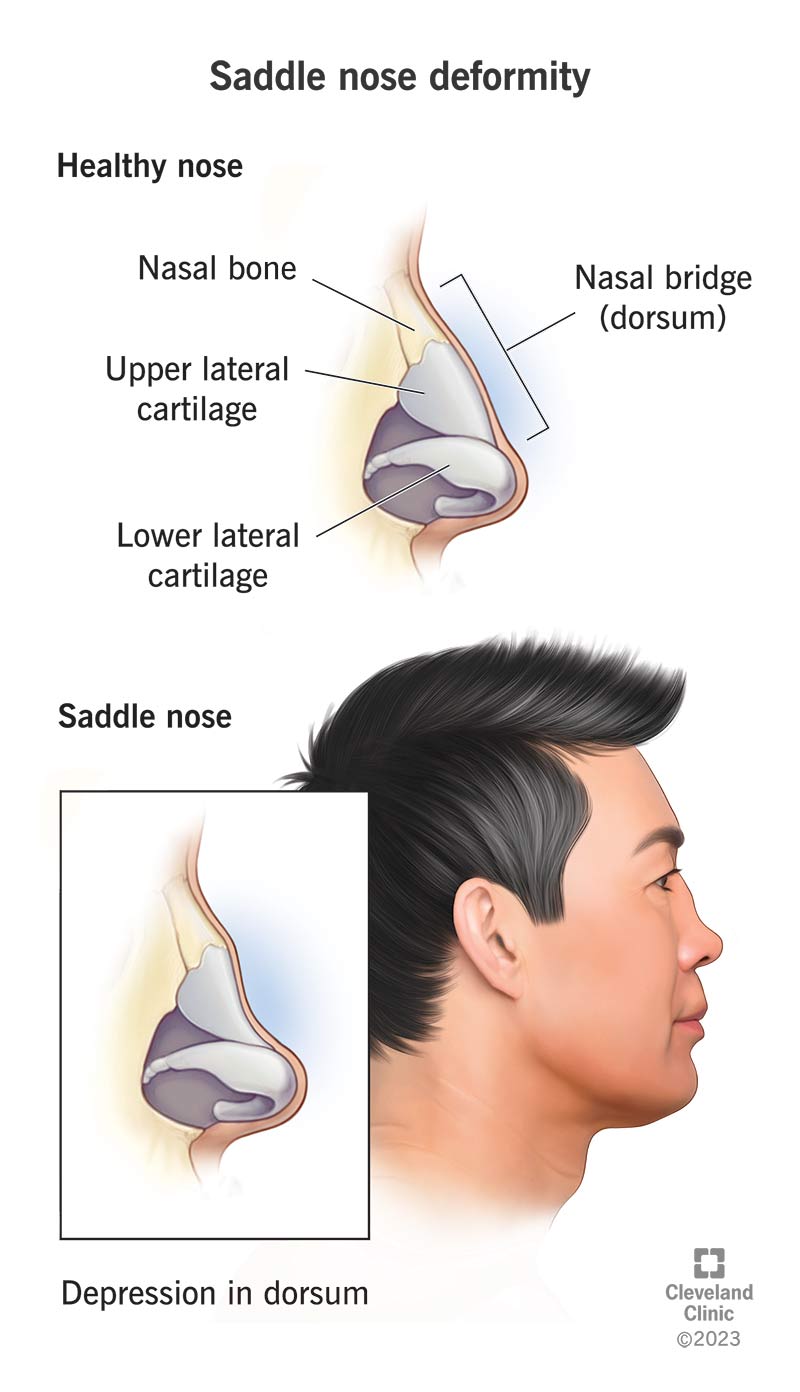 short nose saddle