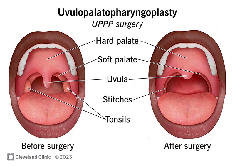 Before and after UPPP surgery: The inside of the mouth with and without tonsils and the uvula.