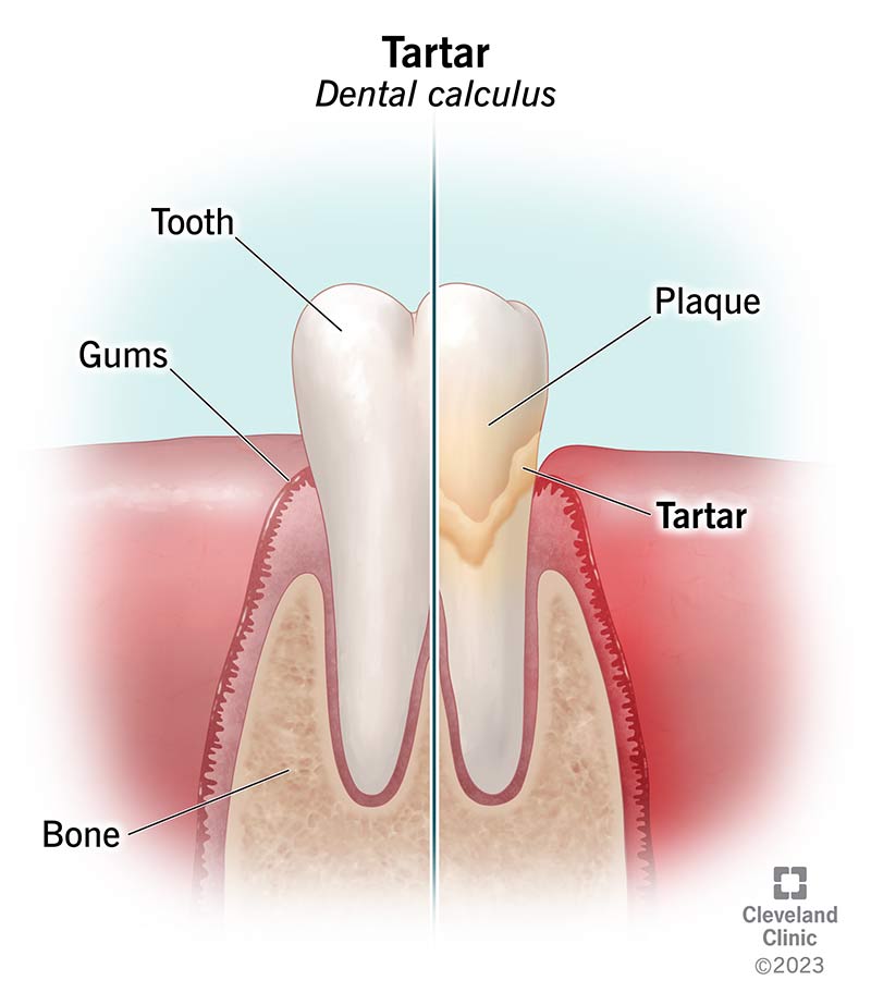 Tooth without tartar vs. tooth with tartar buildup.