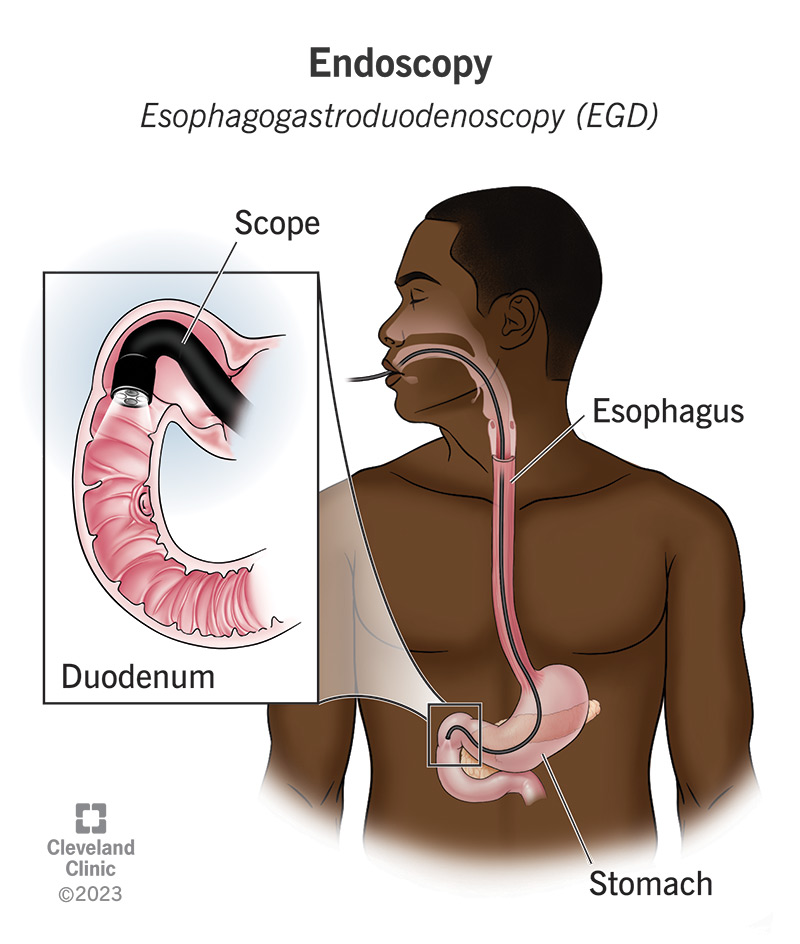 A scope traveling through the mouth, esophagus and stomach until it reaches the duodenum, the top of the small intestine.