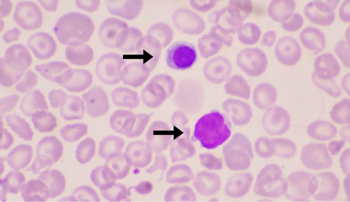 Two reticulocytes, one purple and one blue, on a peripheral blood smear.