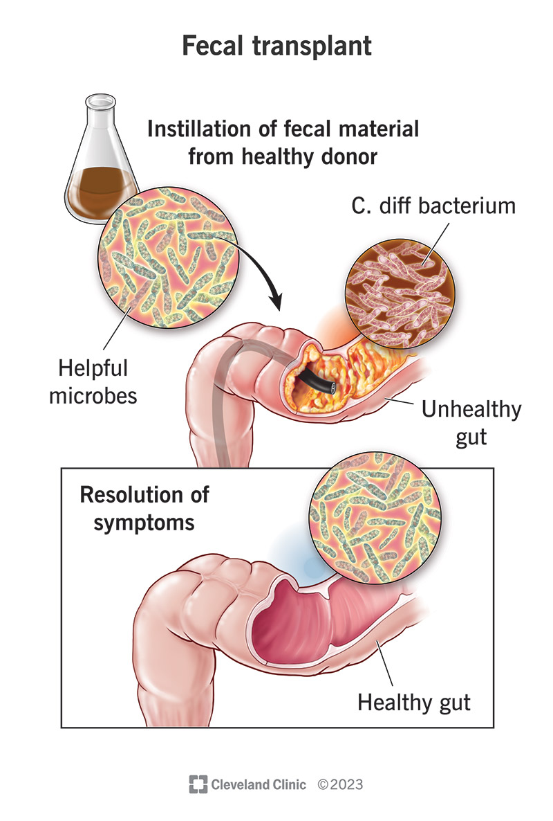 A fecal transplant takes a small stool sample from a healthy colon and puts it in a diseased colon.