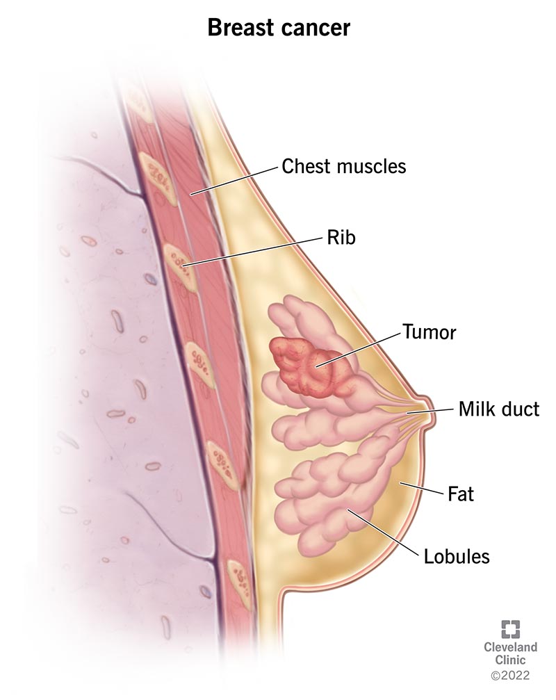 Cancerous tumor inside the breast.