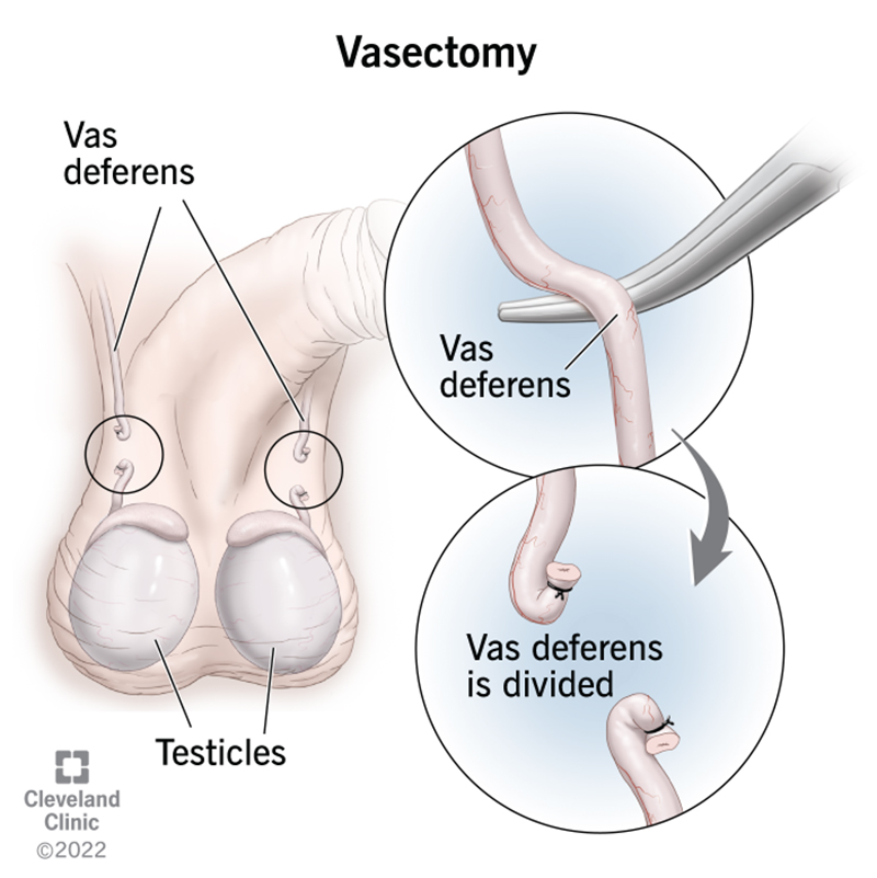 A vasectomy closes off the ends of the vas deferens, which are the tubes that carry sperm from the testicles to outside the body.
