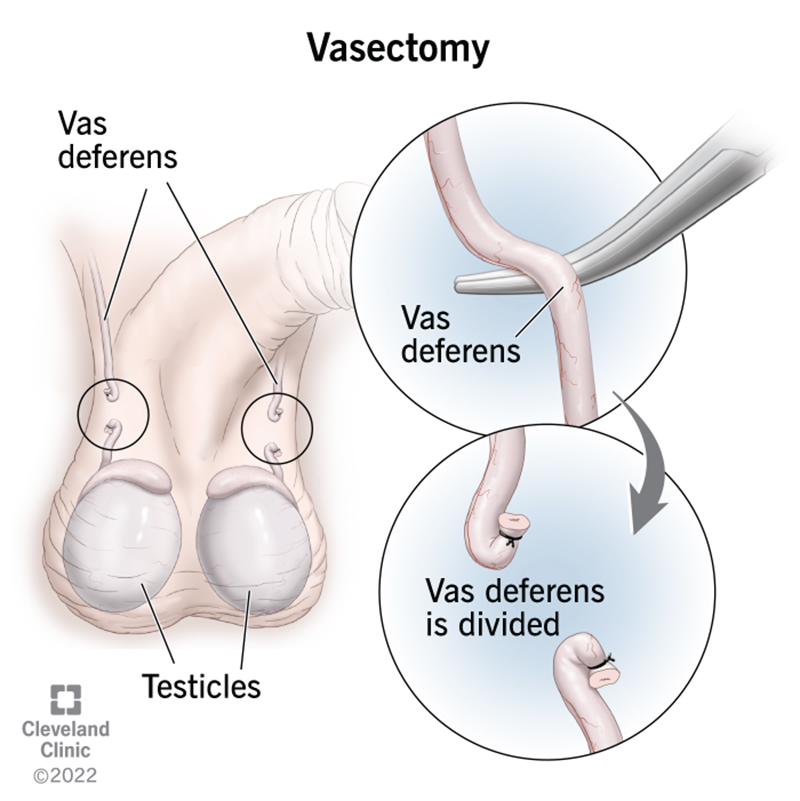 True Relationships & Reproductive Health - Is recovery from a Vasectomy  long and painful? Most patients are fully recovered from their vasectomy  within a week, are back at work and also back