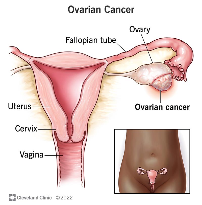Ovarian cancer tumor.