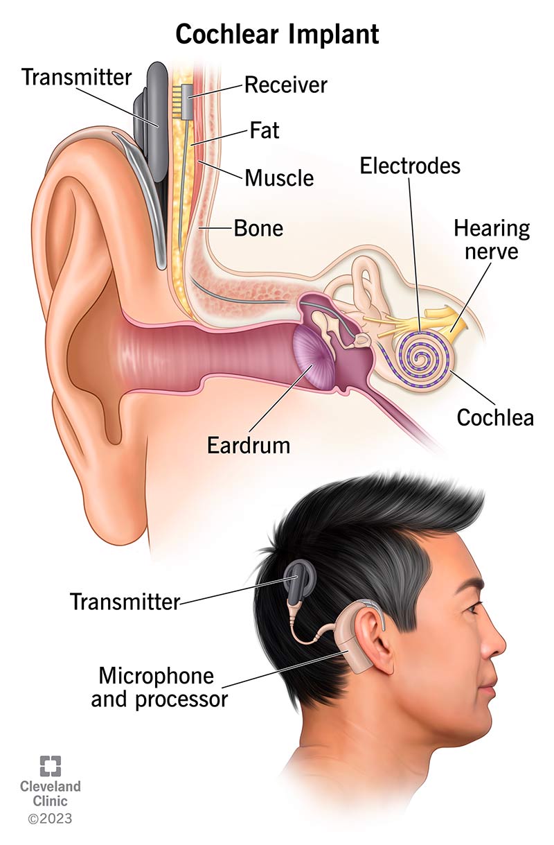 Top. Internal view. Transmitter (left) sends electric impulses to receiver (right). Impulses travel past your eardrum (middle left) to electrodes in your cochlea (middle right). The electrodes send impulses to your hearing nerve (far right). Bottom. External view. Microphone and processor behind ear work by picking up and sorting external sounds and sending them to transmitter (on head).
