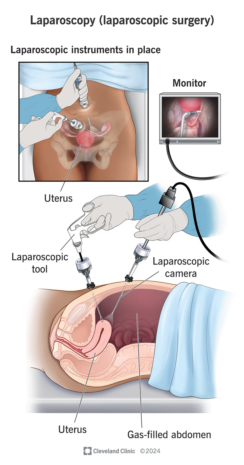 Surgeon doing laparoscopic surgery on uterus using laparoscopic instruments, a camera and a viewing screen.