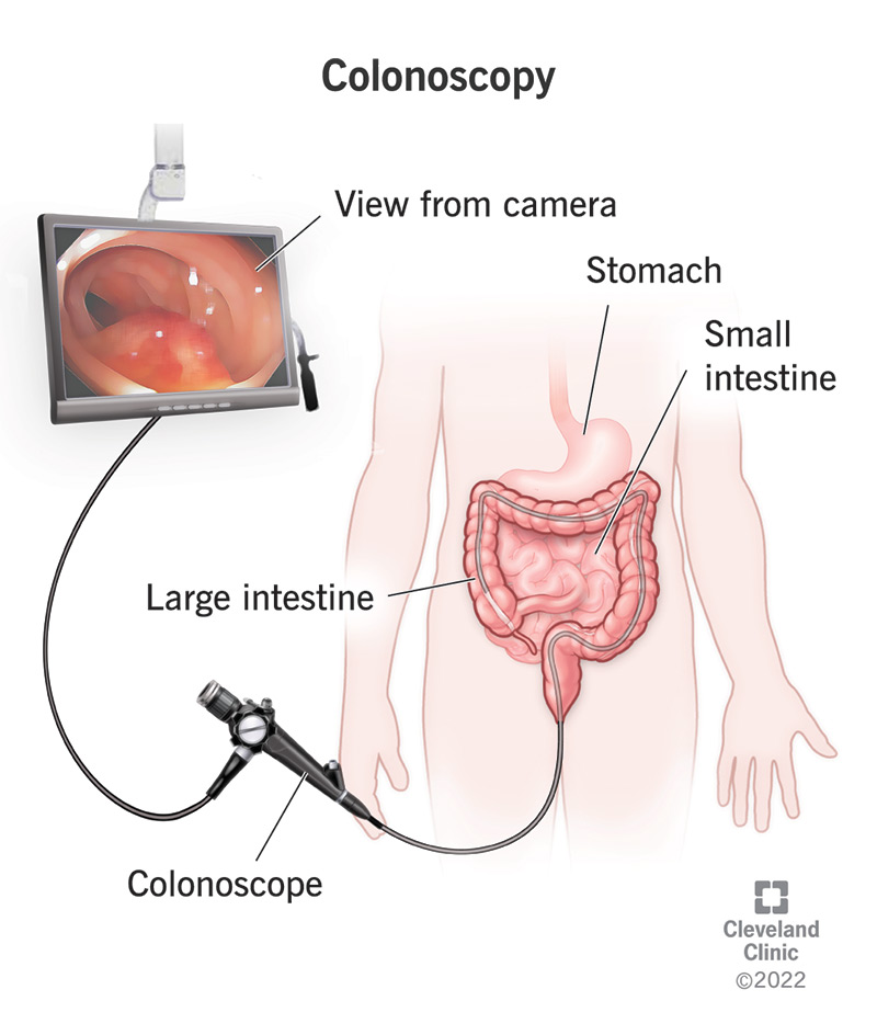 The colonoscope passes through your large intestine, projecting images to a screen.