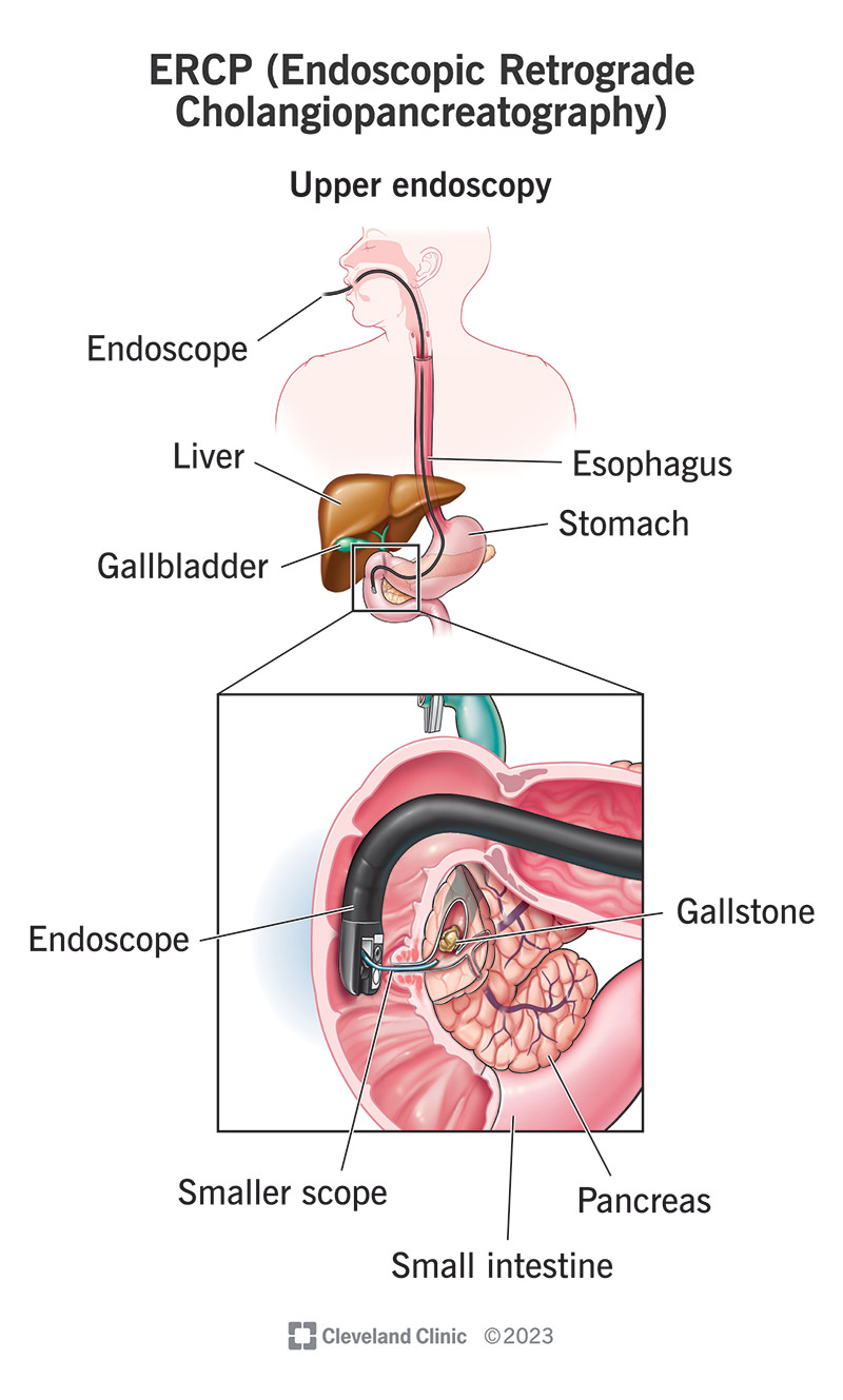 An ERCP involves passing a tiny scope down your throat and through your stomach, all the way into your biliary tract.