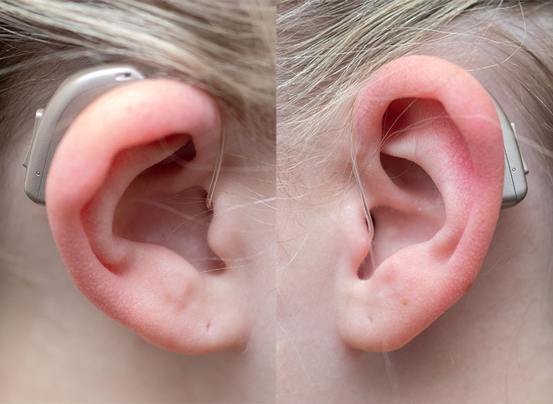 Young girl's ear wearing CROS/BiCROS type of earing aid.