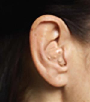 In-the-ear (ITE) hearing aid device.